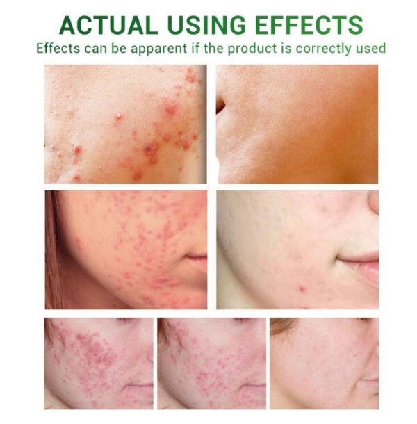 Suero para el tratamiento del acné, aceite reparador facial / Acne Treatment Serum Facial Repair Oil - Imagen 4