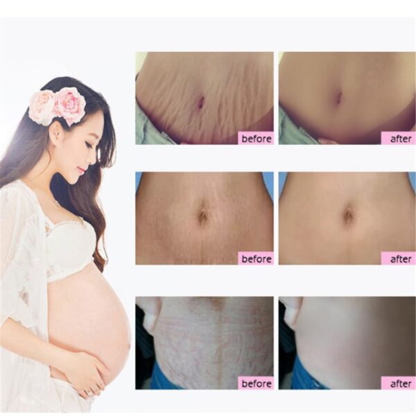 Crema natural suave y no irritante para eliminar las estrías del embarazo, reparar las cicatrices y las líneas de expresión en el abdomen. / Natural Mild Non-irritating Mango Remove Stretch Mark Cream For Pregnancy Repair Scar Slack Line Abdomen Stretch Marks Cream - Imagen 3