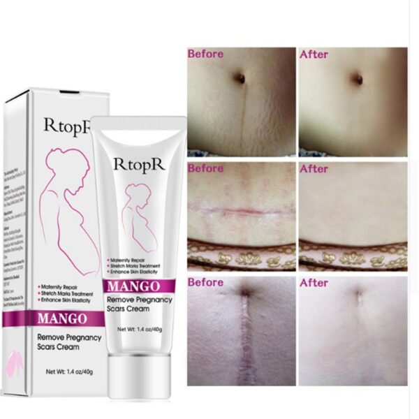 Crema natural suave y no irritante para eliminar las estrías del embarazo, reparar las cicatrices y las líneas de expresión en el abdomen. / Natural Mild Non-irritating Mango Remove Stretch Mark Cream For Pregnancy Repair Scar Slack Line Abdomen Stretch Marks Cream - Imagen 2